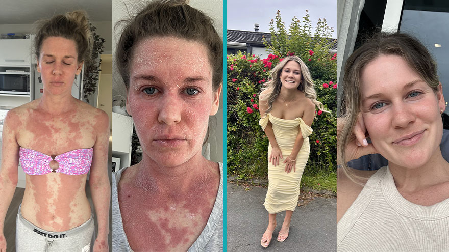 Healing topical steroid withdrawal with Becky Bouterey