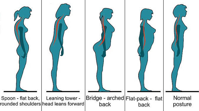 How Your Posture Determines Whether You Will Get Back Pain