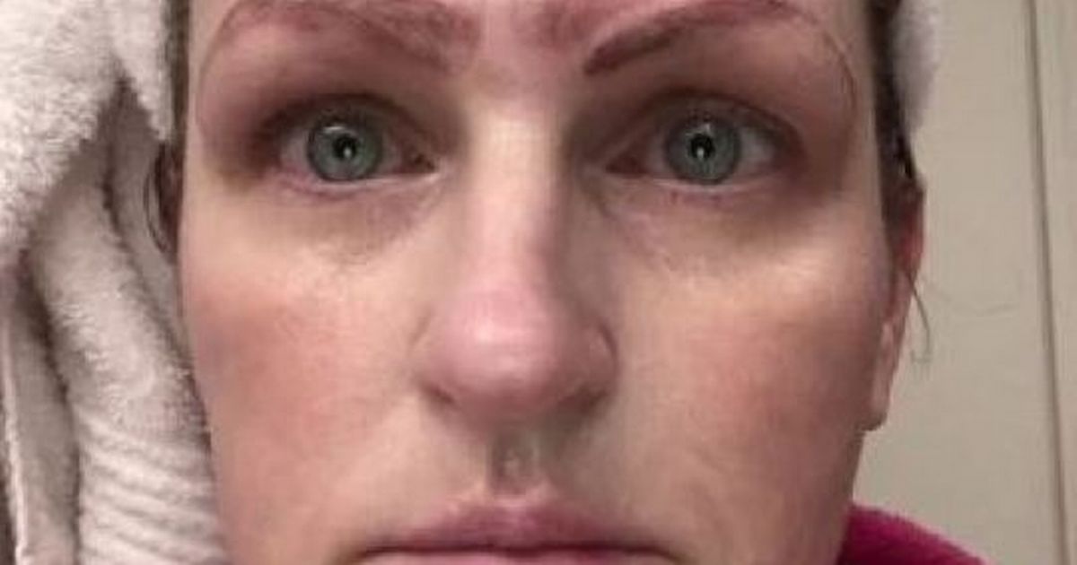Woman left with FOUR eyebrows after botched microblading