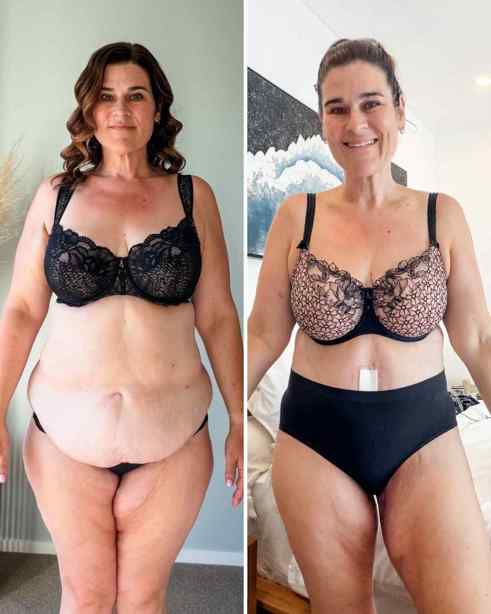 Photo showing Justine Shera before and after her tummy tuck surgery